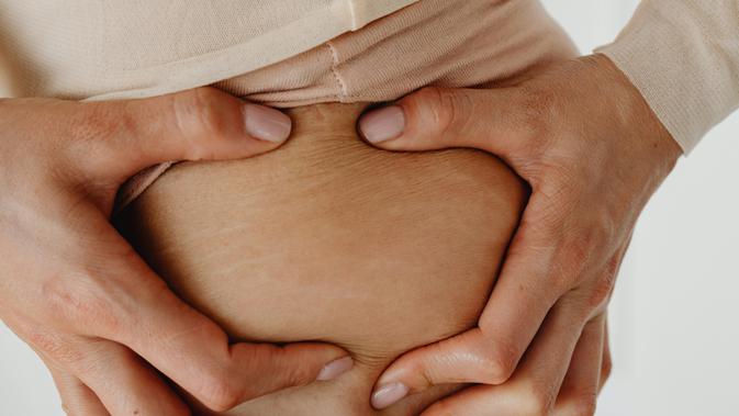 Pria Juga Mengalami Stretch Mark: Fakta, Penyebab, dan Cara Mencegahnya