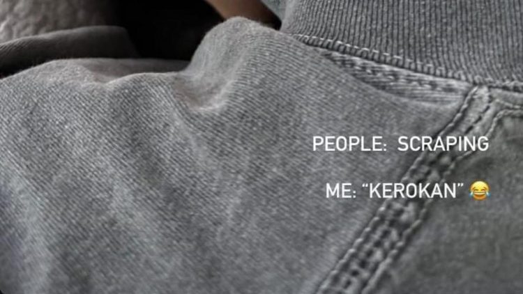 Agnez Mo Heboh Unggah Foto Leher Memerah, Ketahui Manfaat dan Risiko Kerokan