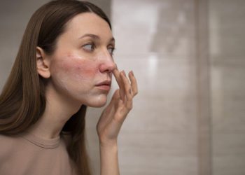 Rosacea Menyebabkan Wajah Merah Berkepanjangan, Ketahui Gejala dan Cara Penanganannya