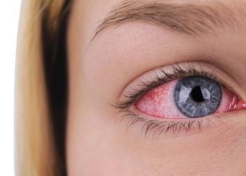 Urat Merah di Mata, Apakah Berbahaya? Penjelasan Lengkapnya