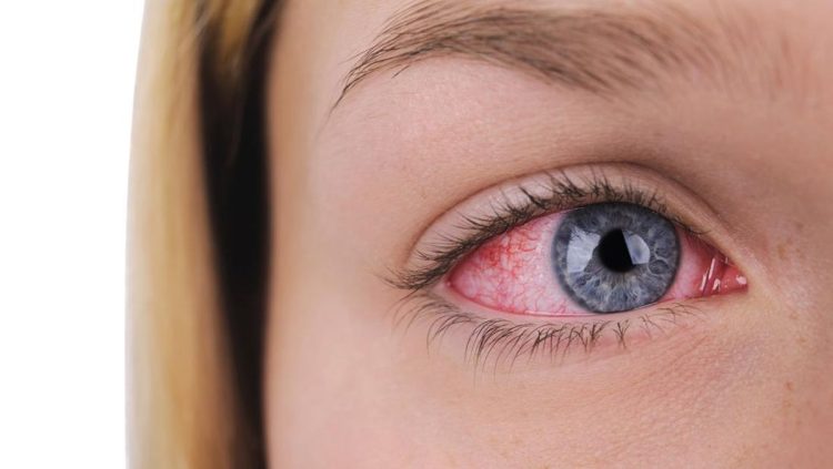 Urat Merah di Mata, Apakah Berbahaya? Penjelasan Lengkapnya