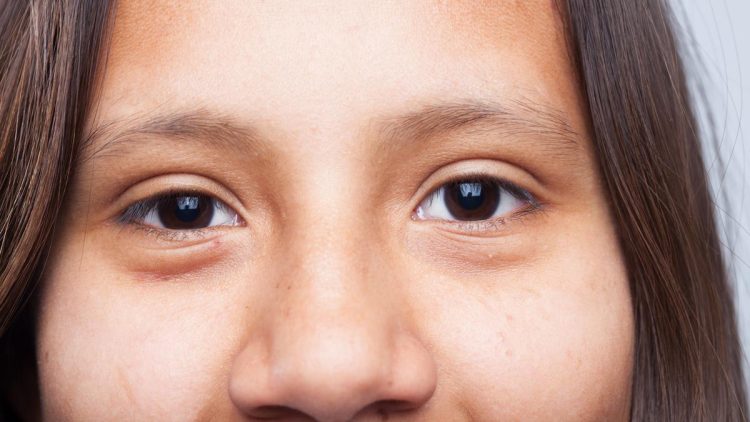 Fakta tentang Ptosis, Kondisi Medis yang Sering Dikenal Sebagai Mata Terlihat Ngantuk